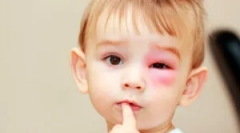 O tome kako ukloniti oticanje nakon ugriza kukaca